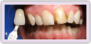 Beforewhiteningphoto2